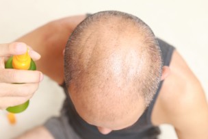 育毛剤を使う薄毛の男性