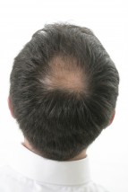 Cavietie,chute des cheveux